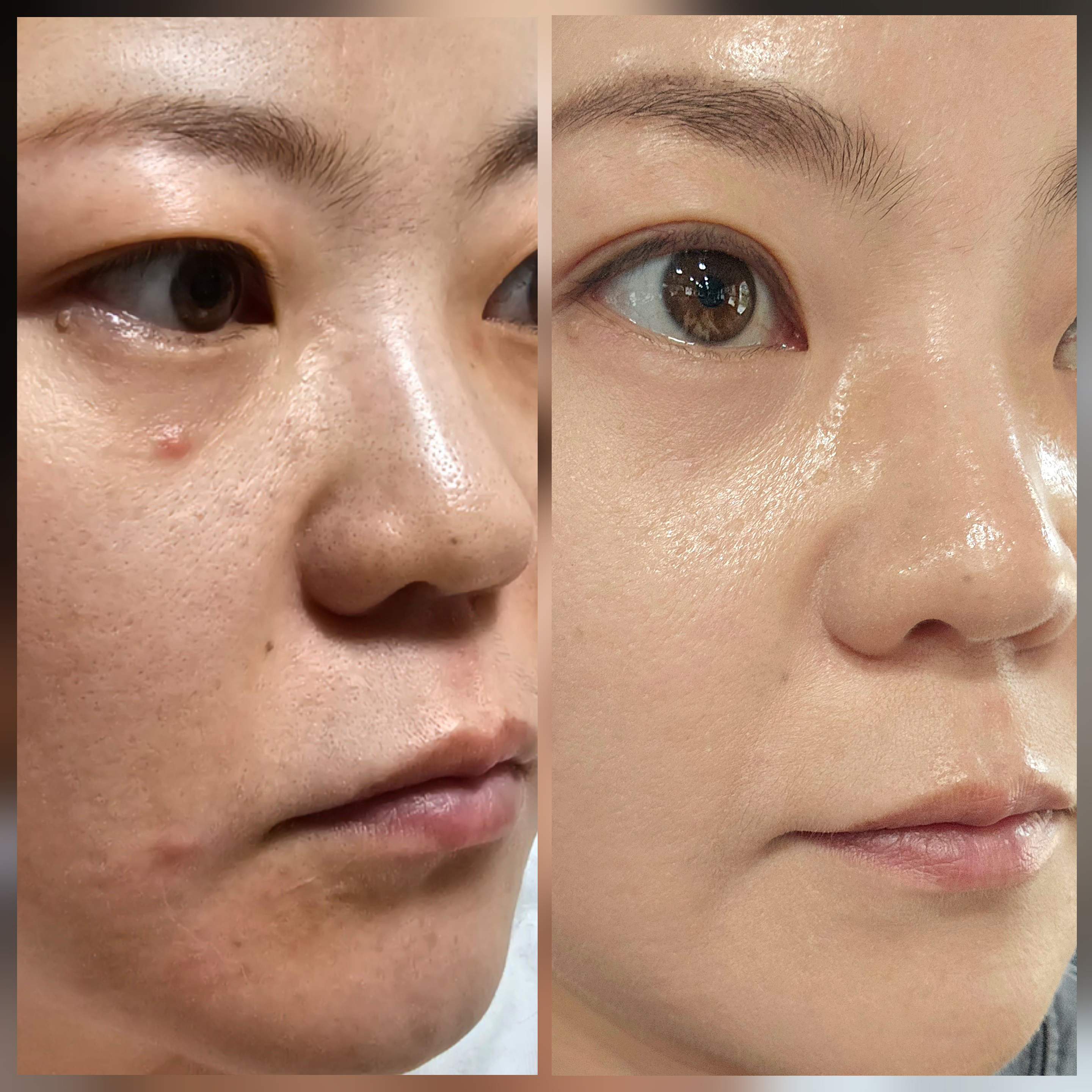 세포랩에센스 1달 사용 전 후 비교 사진 모공과 피부결 잡티 안색 등 많은 피부 문제들이 개선되었다