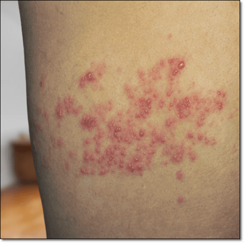 엠폭스 증상 원인 및 발진