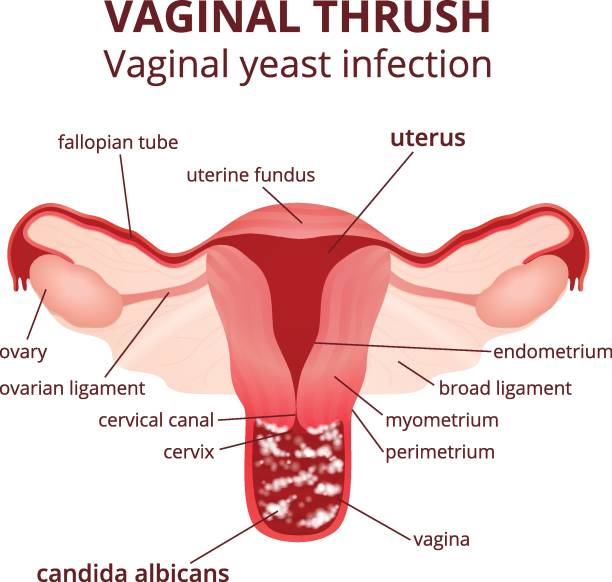 질염이-발생했을때-자궁-모습