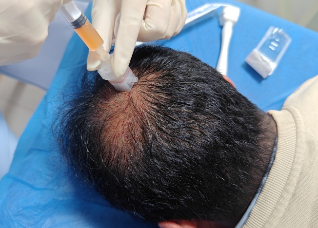 중년남성이병원에서탈모치료주사를맞고있는모습