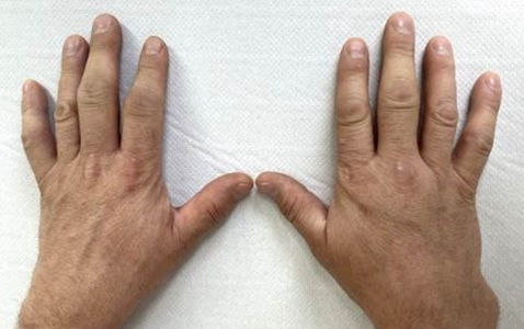 통풍 초기증상2