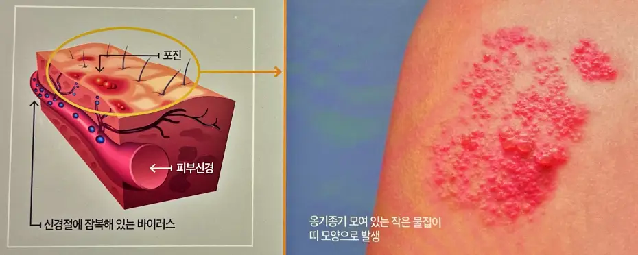 대상포진의 원인은 나이에 따른 면역력 저하가 주원인 입니다.