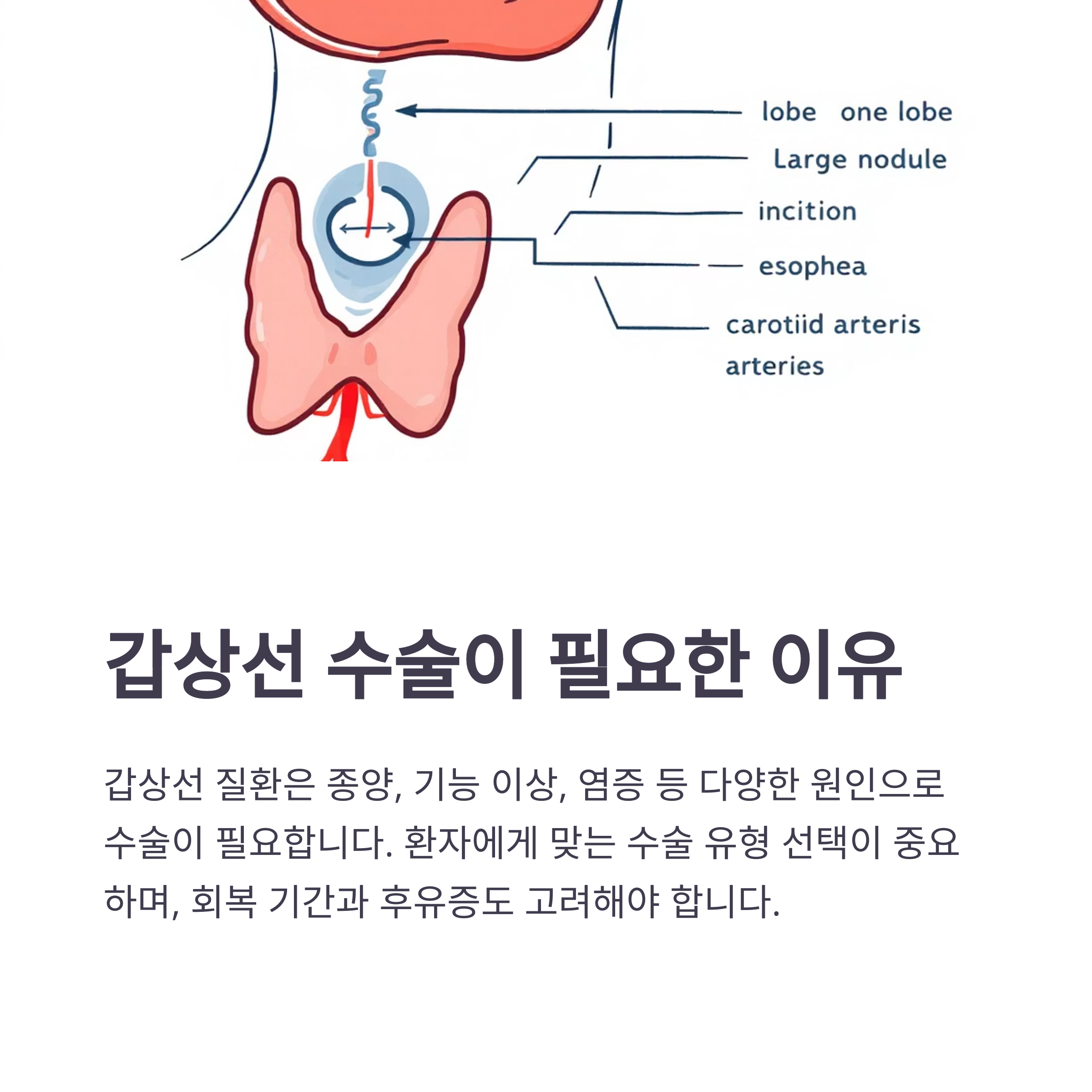 갑상선 수술 전후 완벽 가이드: 종류, 비용, 회복과 후유증까지