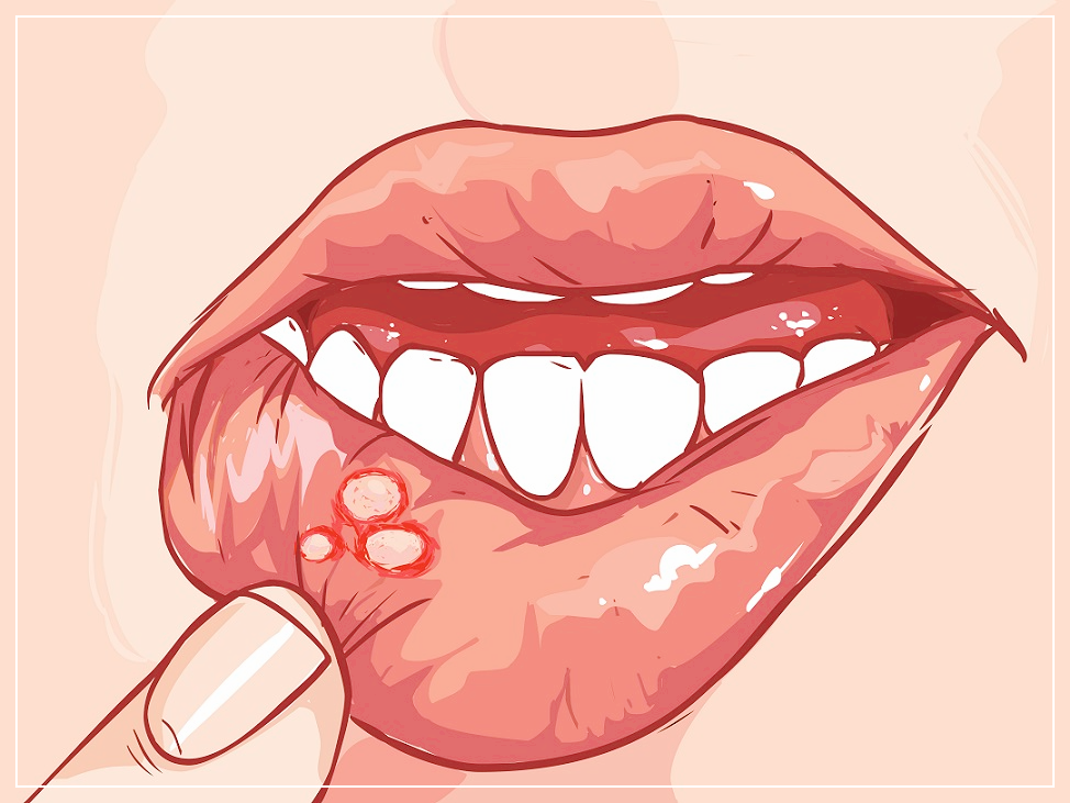 구내염에-좋은-음식