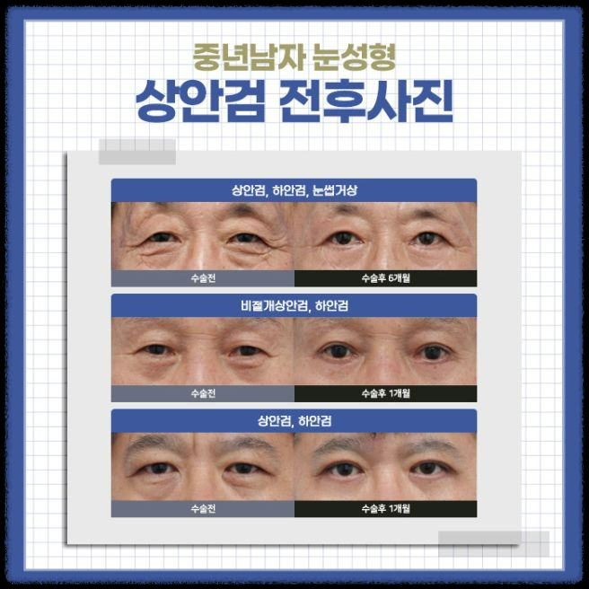 중년의 쌍꺼풀 수술 방법과 병행 가능한 시술 총정리