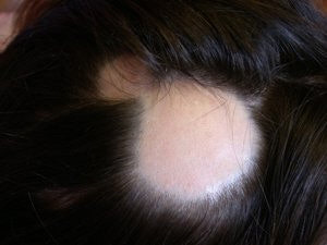 원형탈모가 생긴 머리