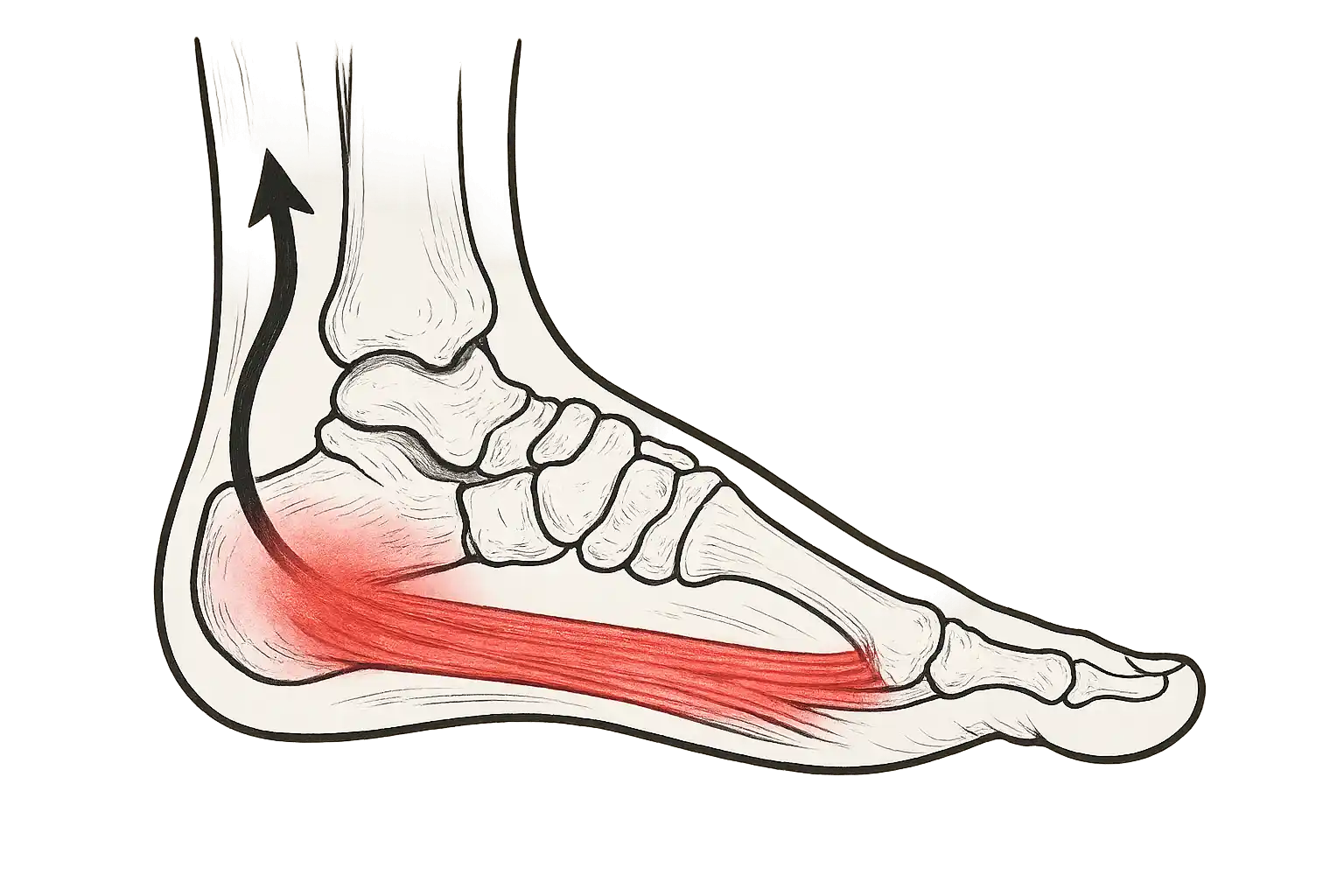 발바닥 근막이 붉게 표시된 해부학적 그림, 통증이 발뒤꿈치에서 발목까지 전달