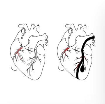 협심증과 심근경색 차이점2