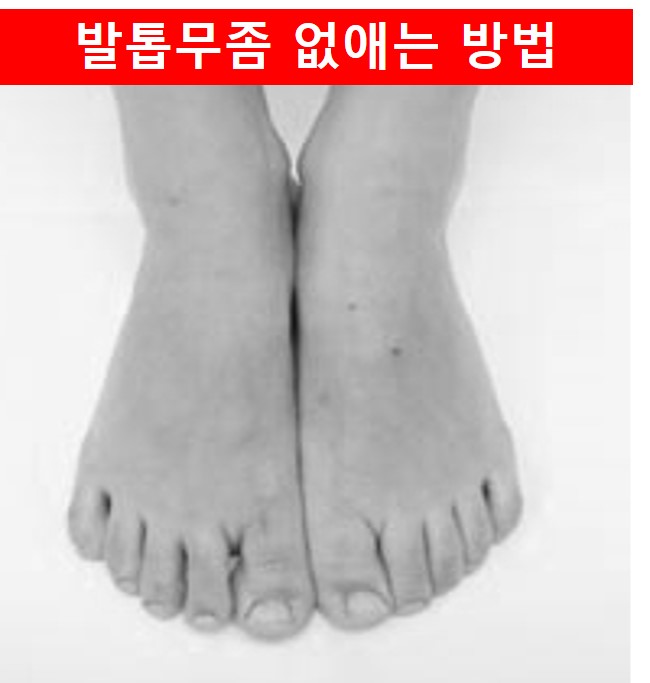 발톱무좀 사진