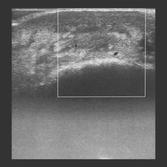 항문 초음파 검사 (Anorectal Ultrasonography) &ndash; 항문질환 진단의 핵심 검사