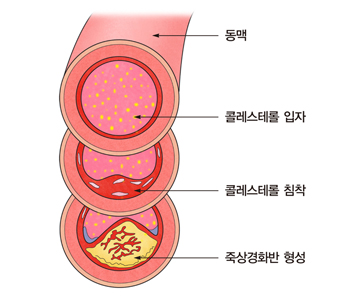 고중성지방혈증 혈관그림