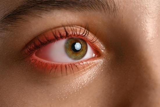 각막염(Keratitis) – 원인, 증상, 치료법