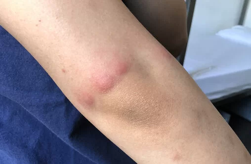 빈대 물린자국 : 빈대 퇴치법&amp;#44; 증상&amp;#44; 예방법