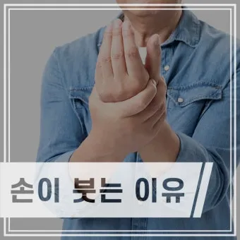 손등 붓는 이유 혈액순환 문제 증상과 해결법 정리_24