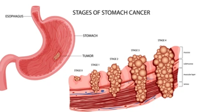 위암 3기 생존율