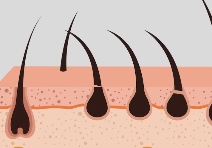 알드로겐성 탈모증 어떻게 치료되나요?