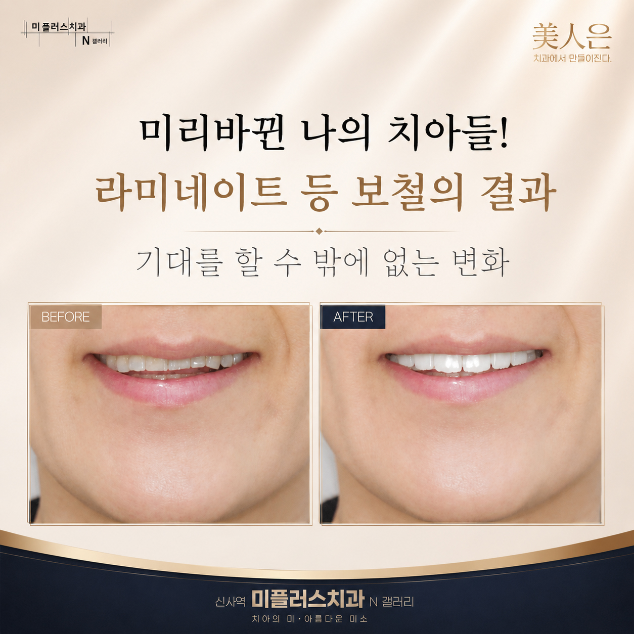 라미네이트 치료 전후 예상 결과를 비교한 디지털 스마일 디자인 시뮬레이션