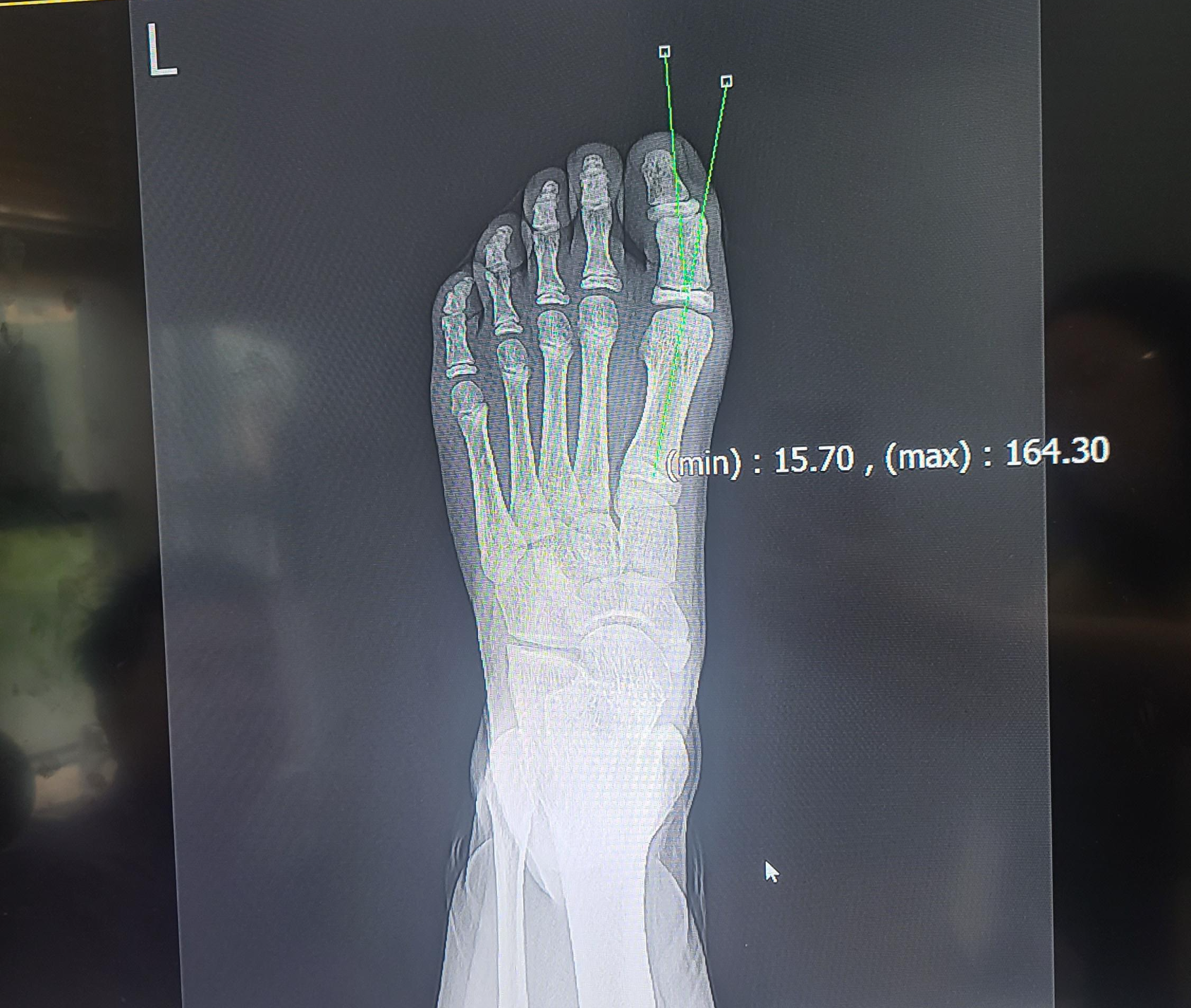 정형외과에서 촬영한 왼발 x-ray