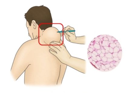 지방종 원인