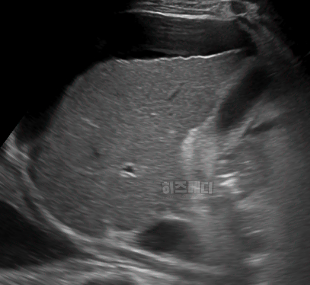 AST ALT 수치 상승