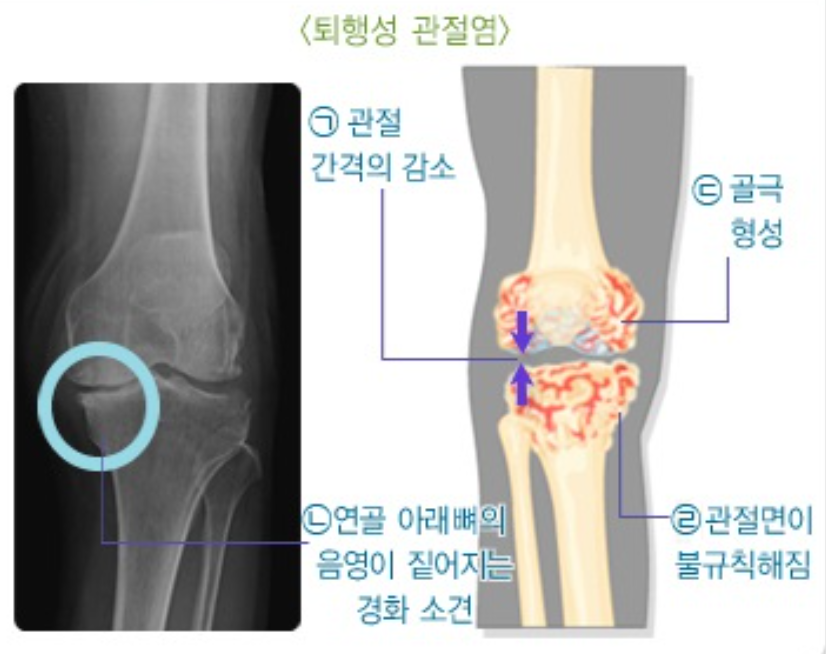 퇴행성관절염 설명