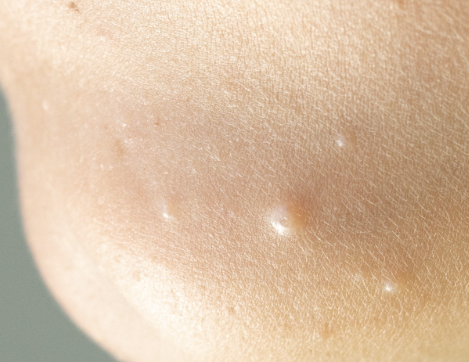 사마귀 제거방법 10가지 총정리 섬네일