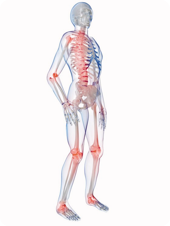 골다공증-치료방법