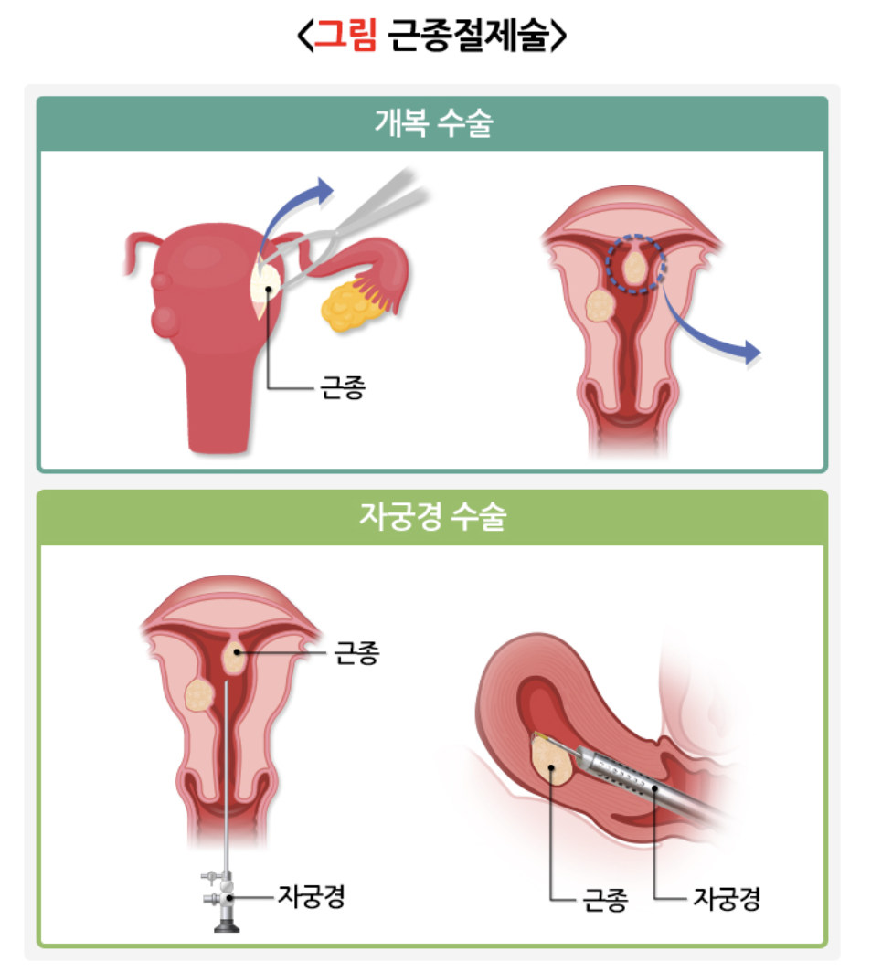 자궁근종 수술