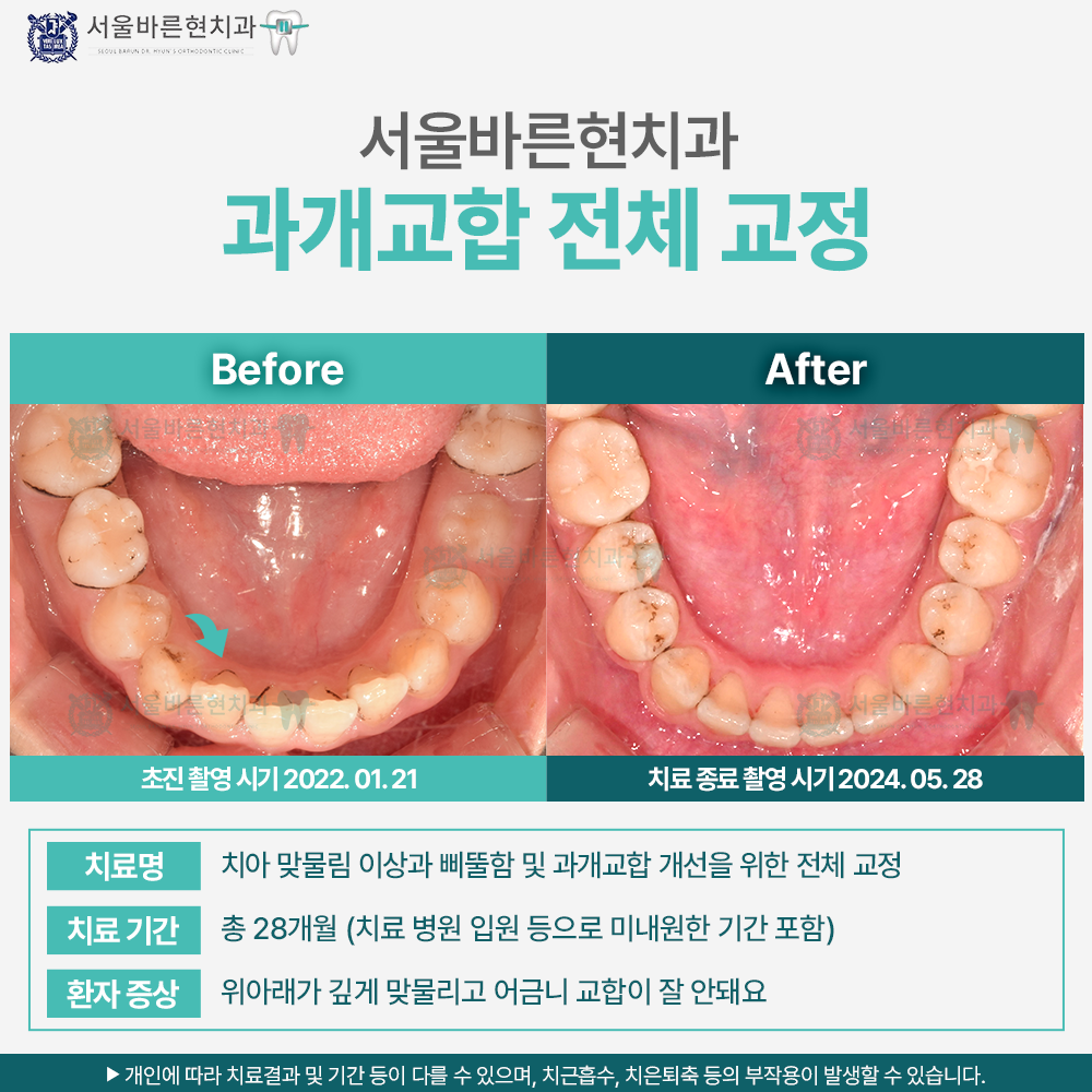 부산치아전체교정