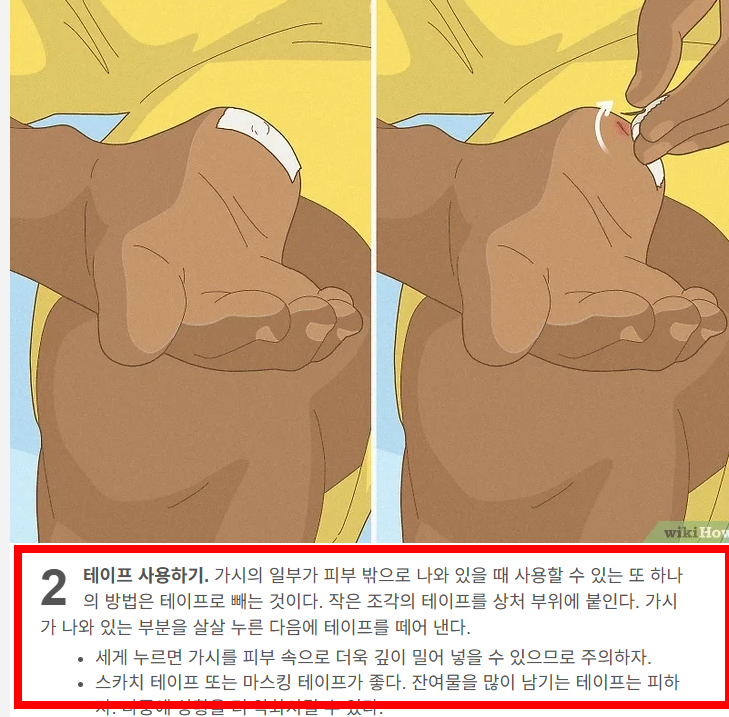손가락 가시 빼는법 소개