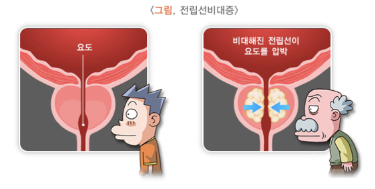 전립서 비대증