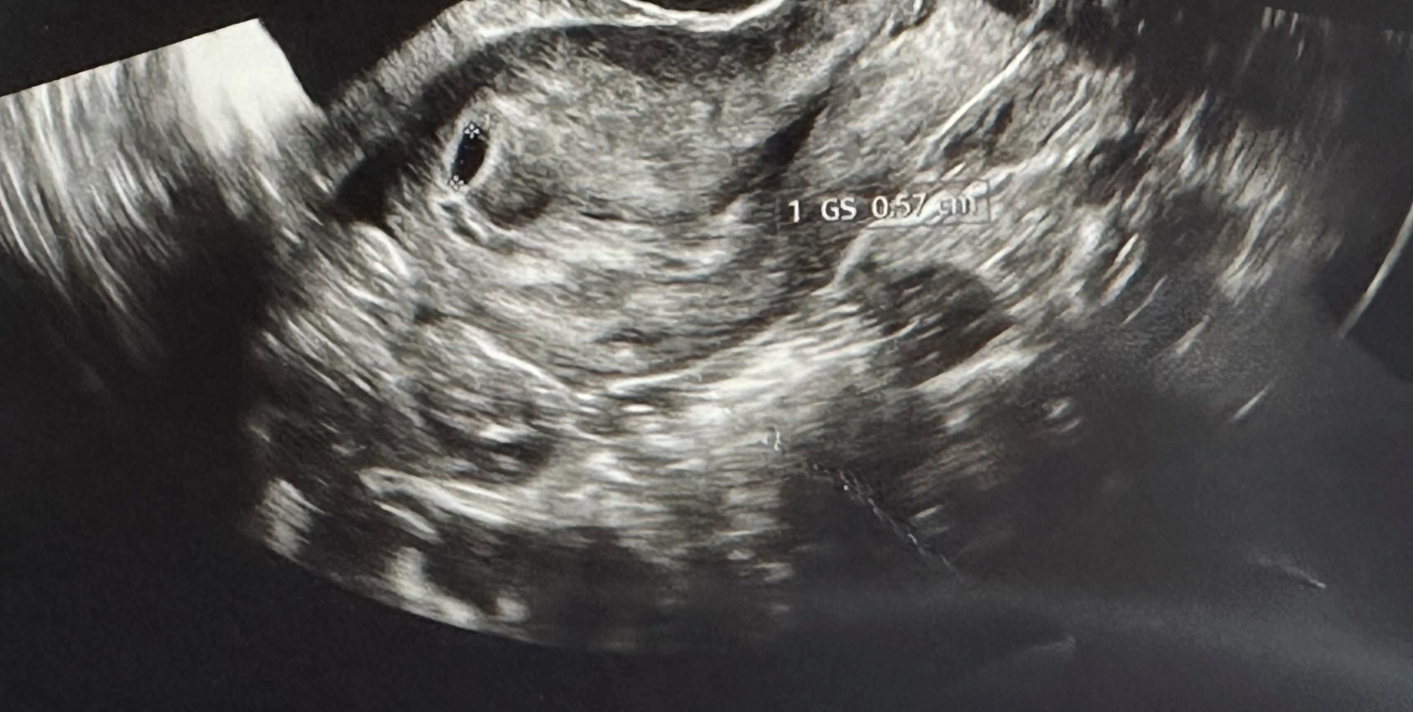 임신-확인-첫-초음파-사진