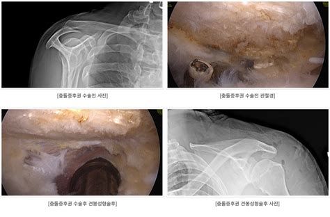 어깨충돌증후군수술