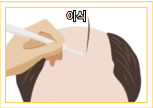 탈모 치료 - 모발 이식