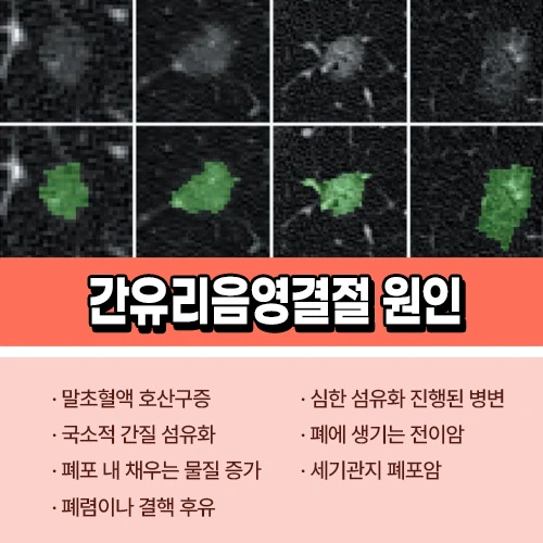 간유리음영 원인