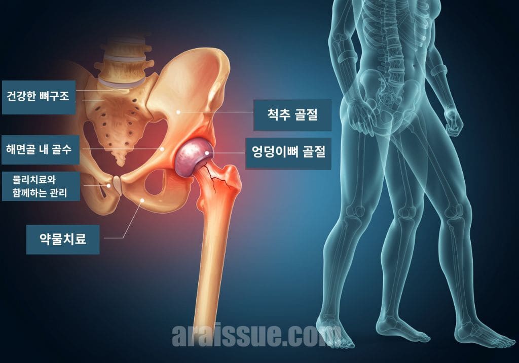 골다공증으로 약해진 뼈와 고관절 골절의 위험을 보여주는 이미지입니다. 회복의 어려움과 일상 기능 상실을 상징적으로 표현하고 있습니다.