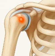어깨 석회질 치료방법