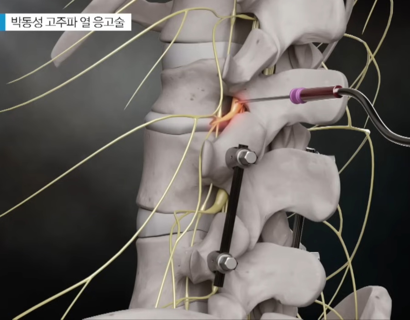 허리디스크-진동규-교수