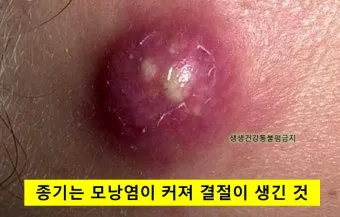 엉덩이 종기가 생기는 이유 왜 생기고 어떻게 관리할까요 완벽 가이드_2