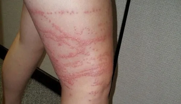 해파리-쏘임-자상