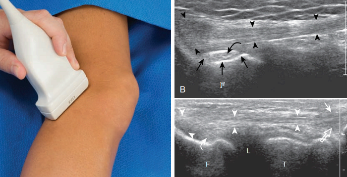 무릎 가쪽 검사
