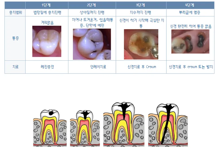 인레이 온레이의 차이와 치료 방법_5