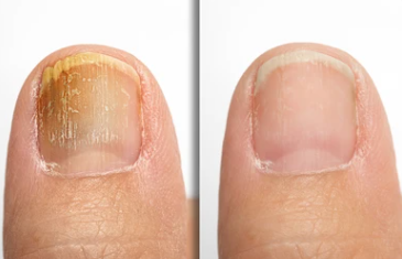 내성발톱 자가치료