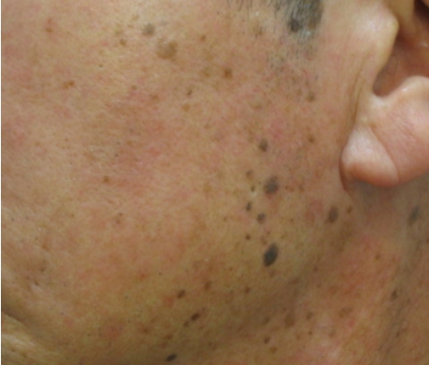 검버섯 없애는 방법