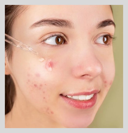 점뺀후 재생테이프 붙이는 기간