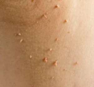 쥐젖이 생기는 이유, 쥐젖 제거방법