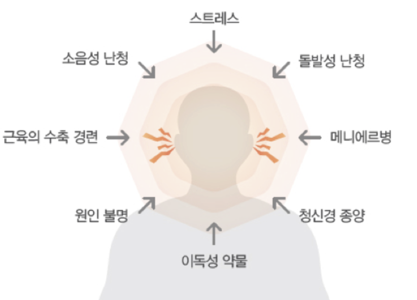 이명 치료 방법 1