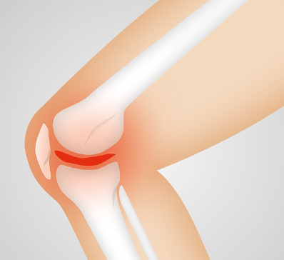 무릎통증 증후군 원인과 증상 제대로 알고 치료에 대응해보자