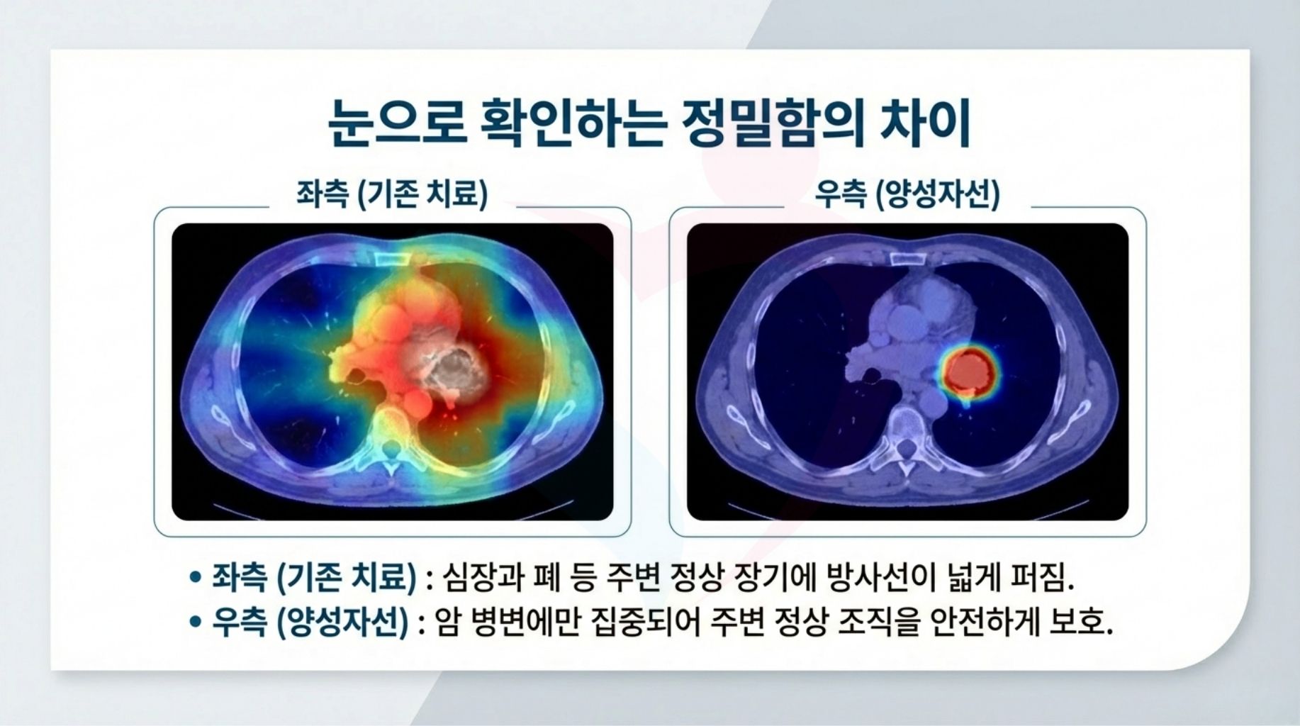 일본 중부국제의료센터 양성자치료 최신장비 ProBeam360