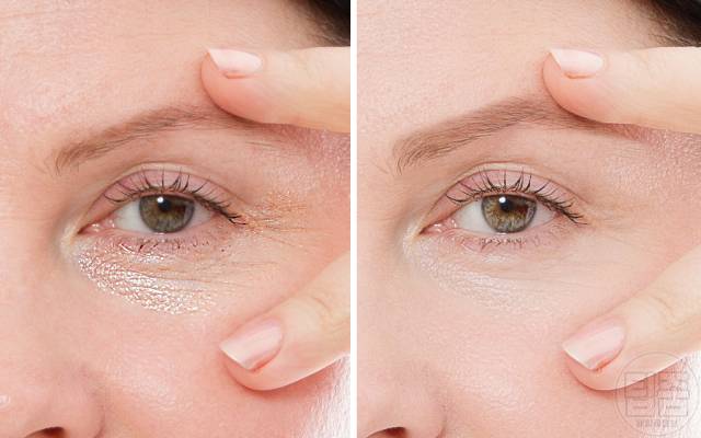 눈밑주름 제거 콜라겐 부족 보충